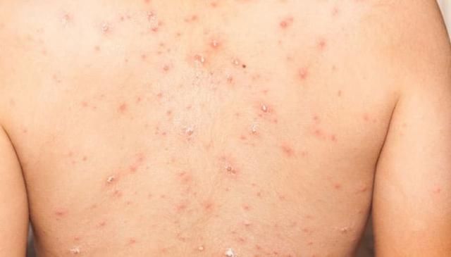 ¿La vacuna de la viruela nos protege de la viruela del mono?
