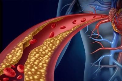 Colesterol alto: qué significa, cómo reducirlo y qué hábitos ayudan de forma natural